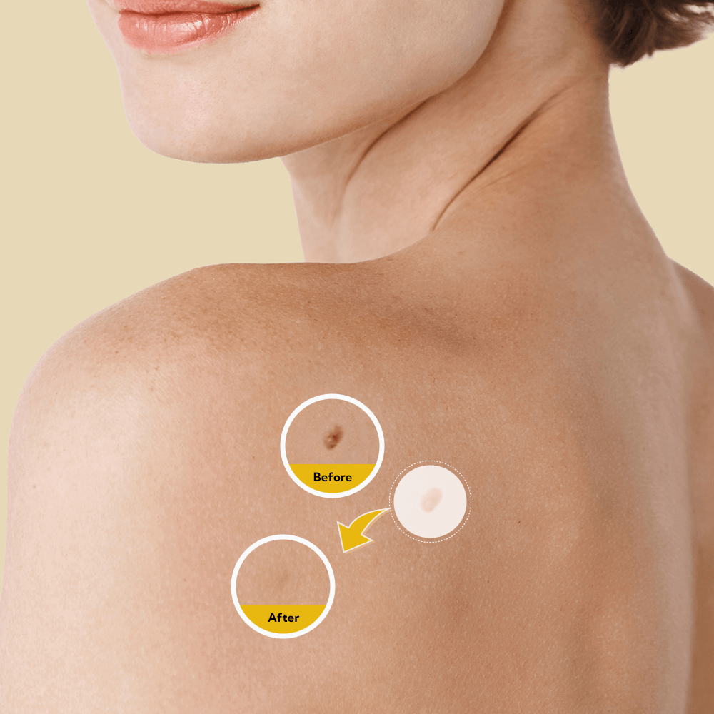 Skin Tag And Mole Removal