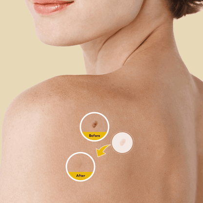 Skin Tag And Mole Removal