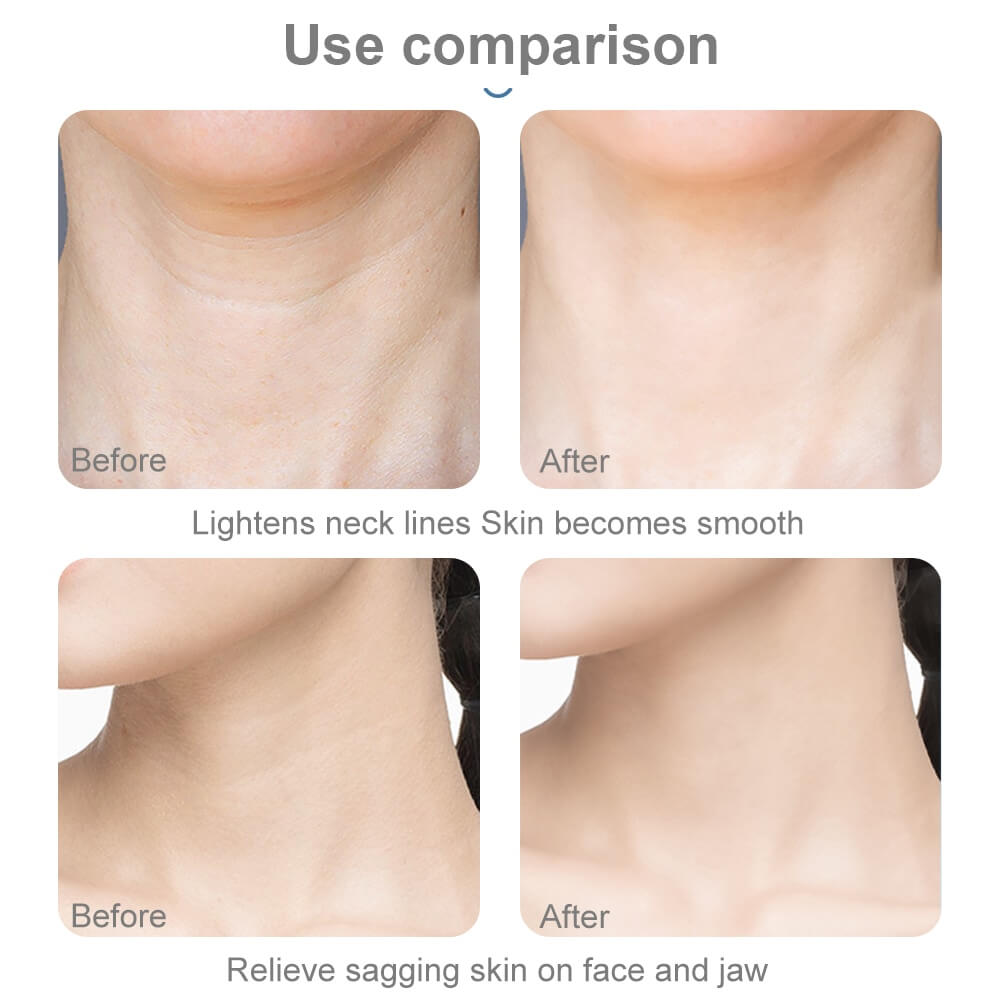 How To Get Rid Of Neck Wrinkles